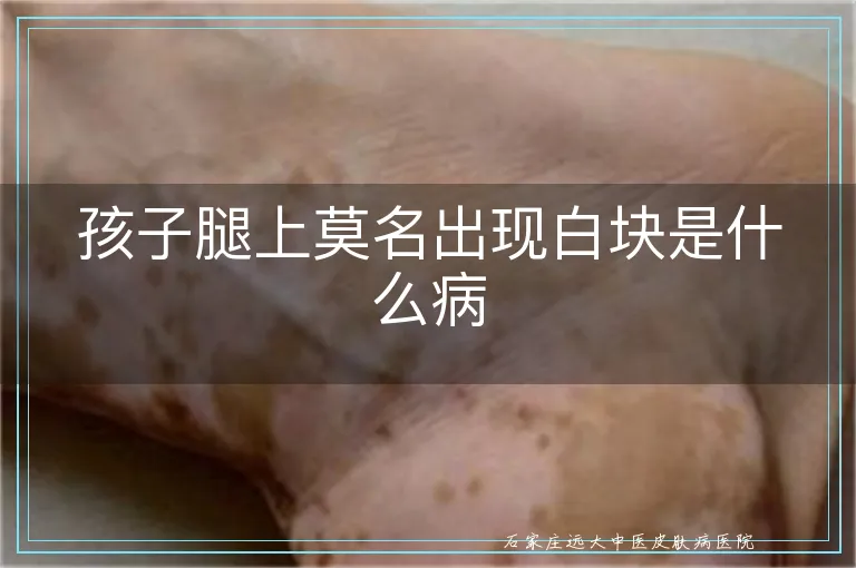 孩子腿上莫名出现白块是什么病