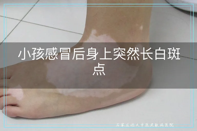 小孩感冒后身上突然长白斑点