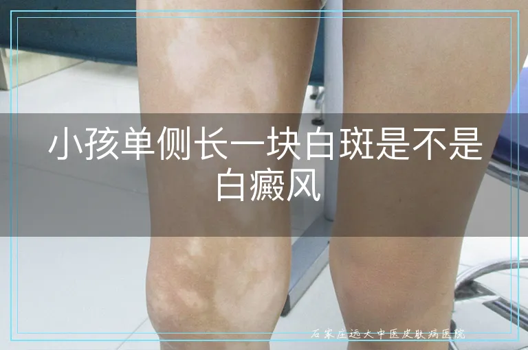 小孩单侧长一块白斑是不是白癜风