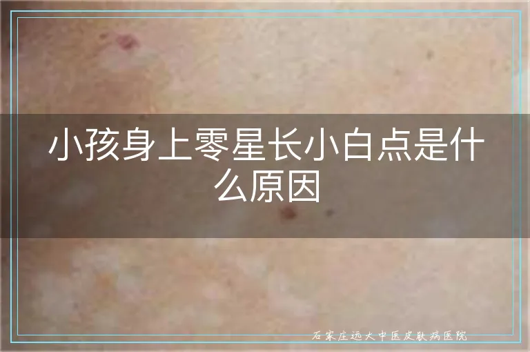 小孩身上零星长小白点是什么原因