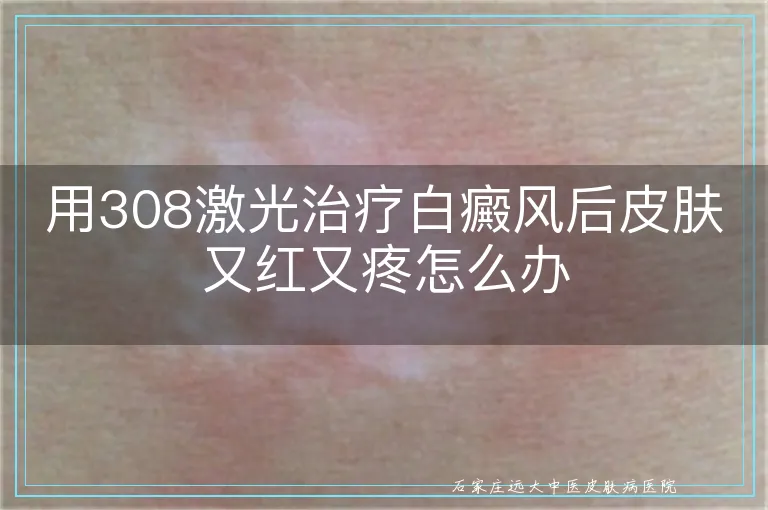 用308激光治疗白癜风后皮肤又红又疼怎么办