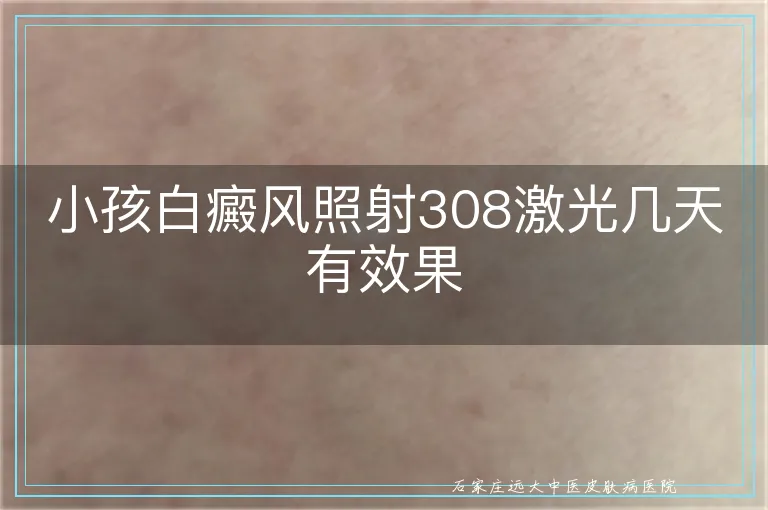 小孩白癜风照射308激光几天有效果