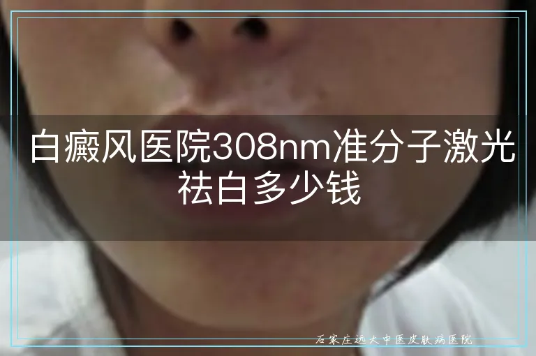 白癜风医院308nm准分子激光祛白多少钱