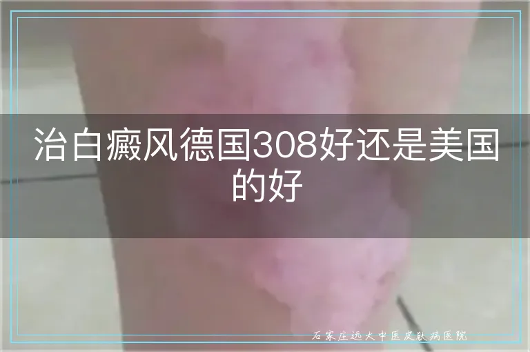 治白癜风德国308好还是美国的好