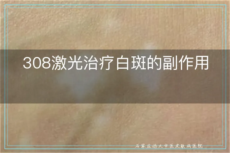 308激光治疗白斑的副作用