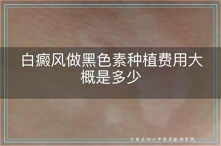 白癜风做黑色素种植费用大概是多少