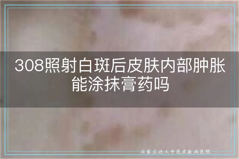 308照射白斑后皮肤内部肿胀能涂抹膏药吗