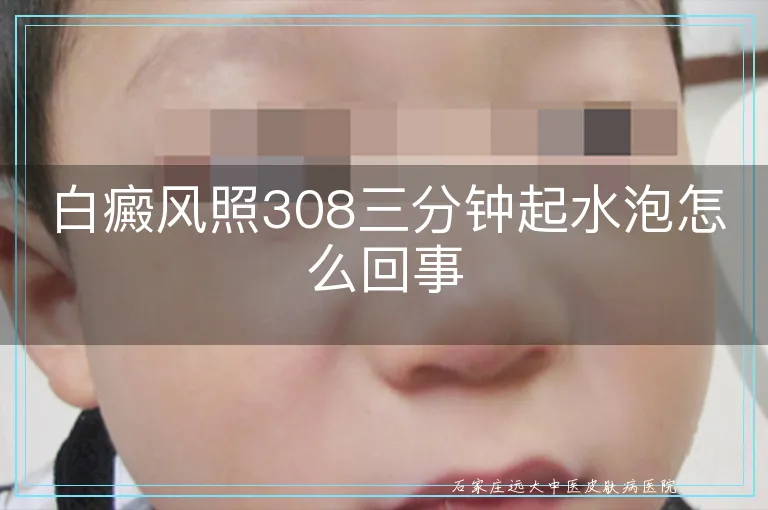 白癜风照308三分钟起水泡怎么回事