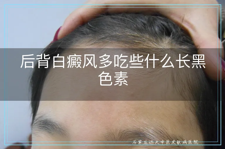 后背白癜风多吃些什么长黑色素