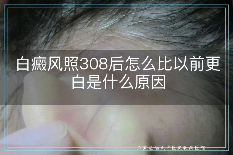 白癜风照308后怎么比以前更白是什么原因