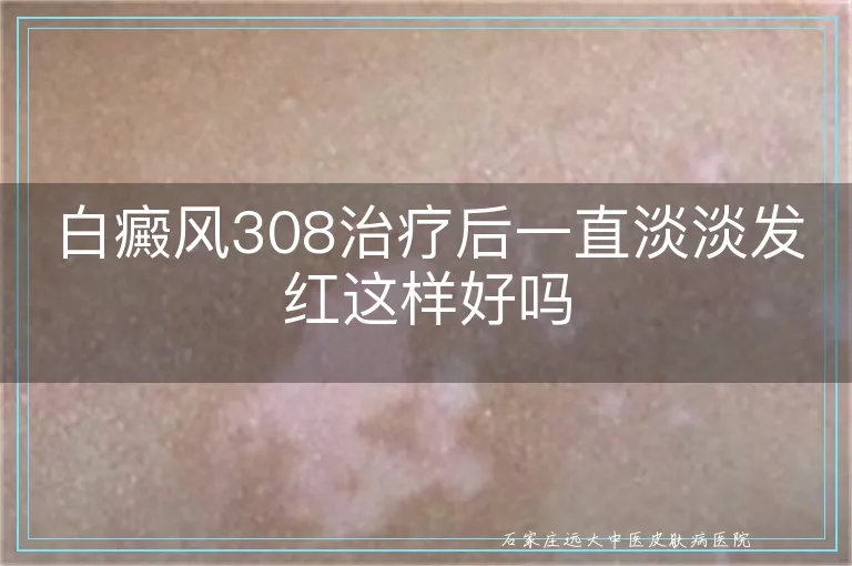白癜风308治疗后一直淡淡发红这样好吗