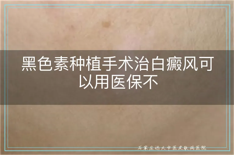 黑色素种植手术治白癜风可以用医保不