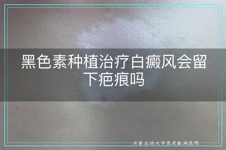 黑色素种植治疗白癜风会留下疤痕吗
