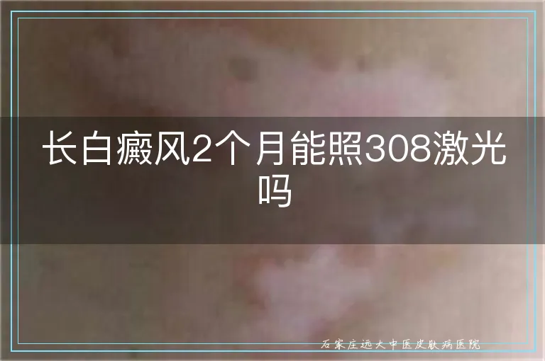 长白癜风2个月能照308激光吗