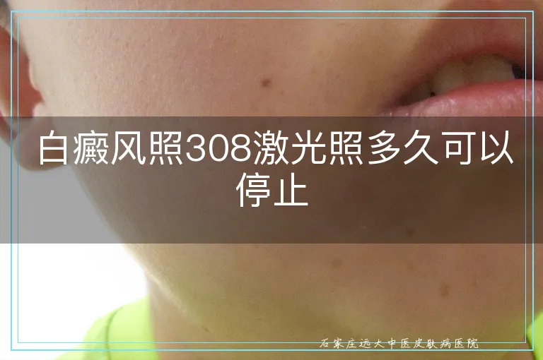 白癜风照308激光照多久可以停止