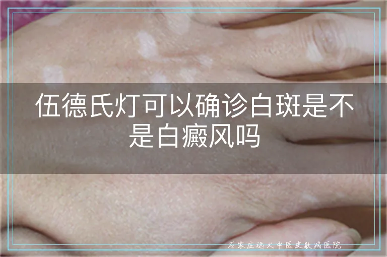 伍德氏灯可以确诊白斑是不是白癜风吗