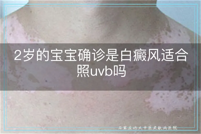 2岁的宝宝确诊是白癜风适合照uvb吗