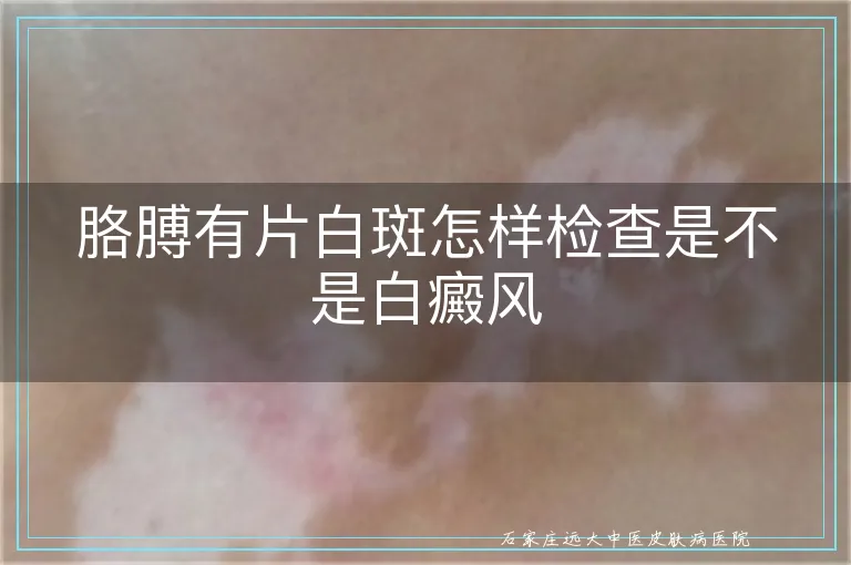 胳膊有片白斑怎样检查是不是白癜风