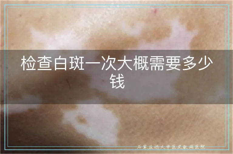 检查白斑一次大概需要多少钱