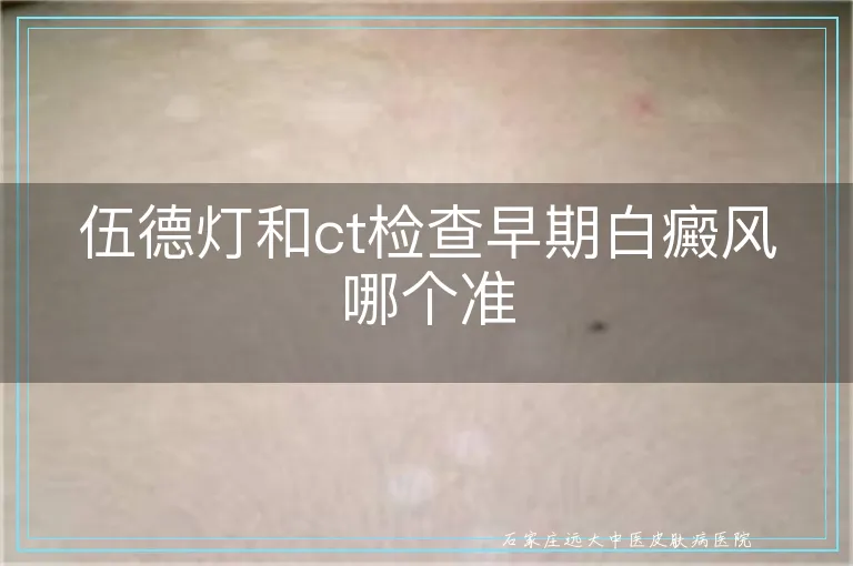 伍德灯和ct检查早期白癜风哪个准