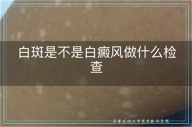 白斑是不是白癜风做什么检查