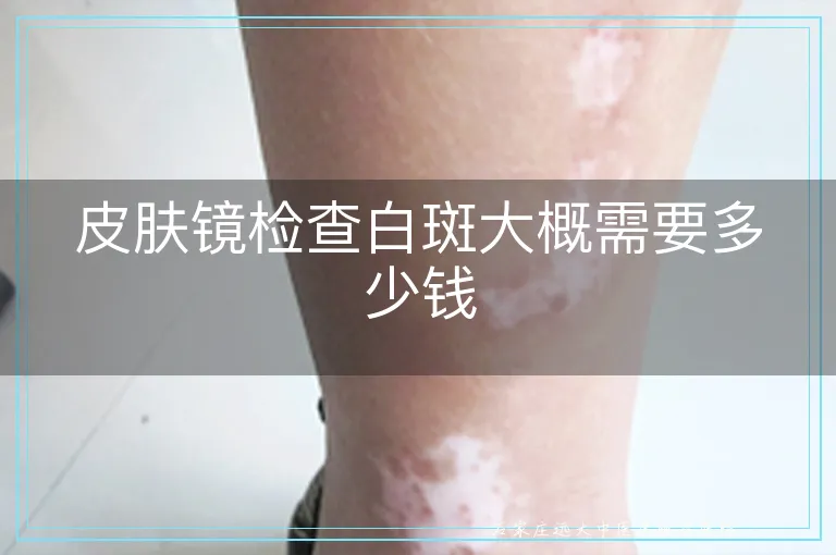 皮肤镜检查白斑大概需要多少钱