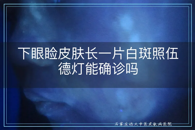 下眼睑皮肤长一片白斑照伍德灯能确诊吗