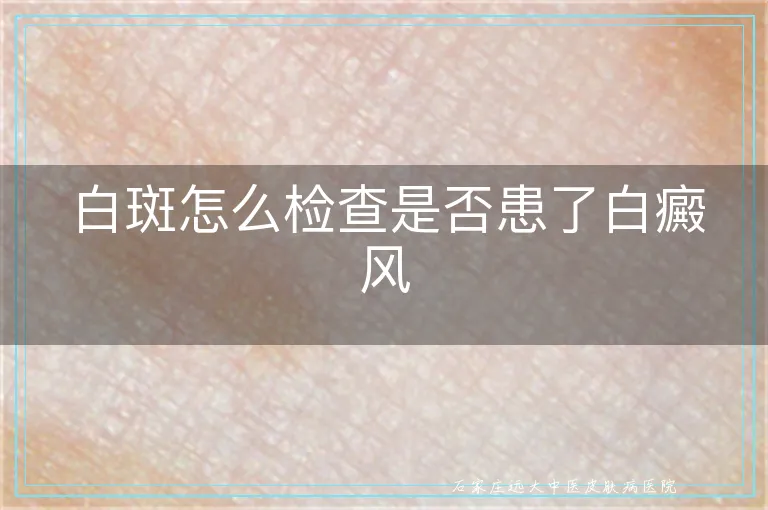白斑怎么检查是否患了白癜风