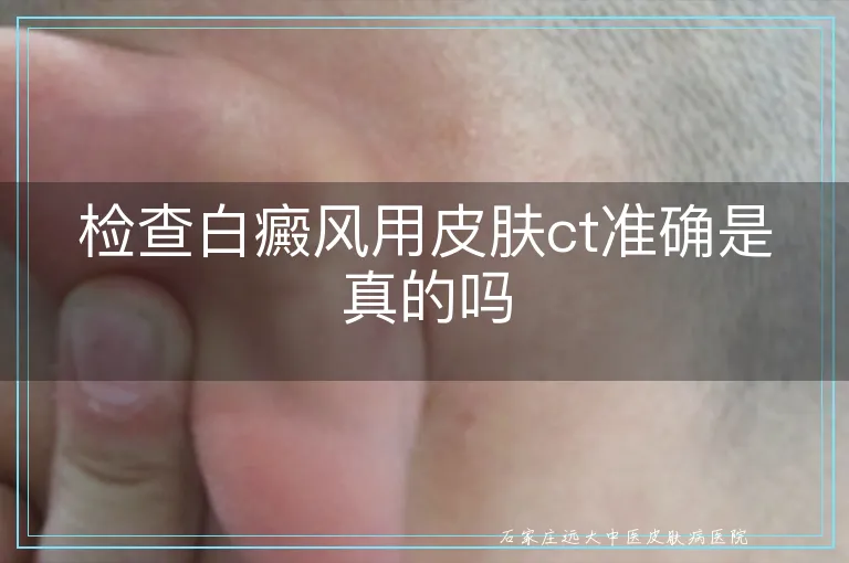 检查白癜风用皮肤ct准确是真的吗
