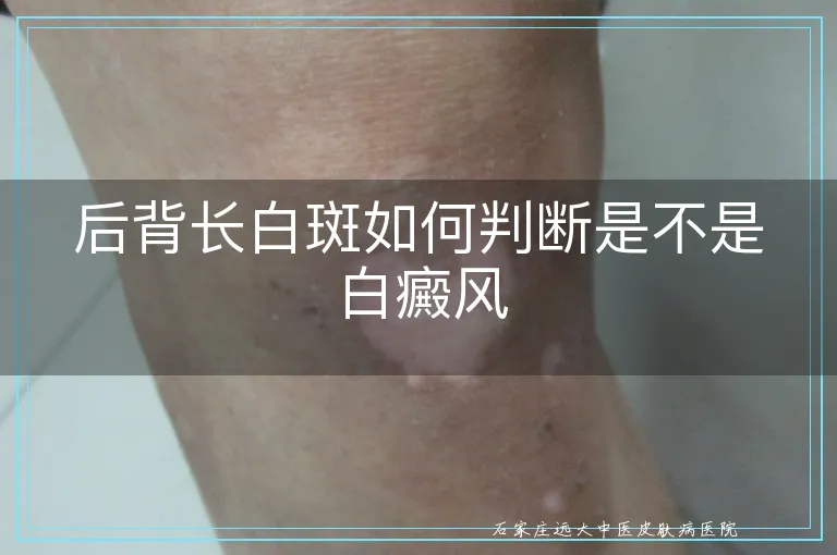 后背长白斑如何判断是不是白癜风