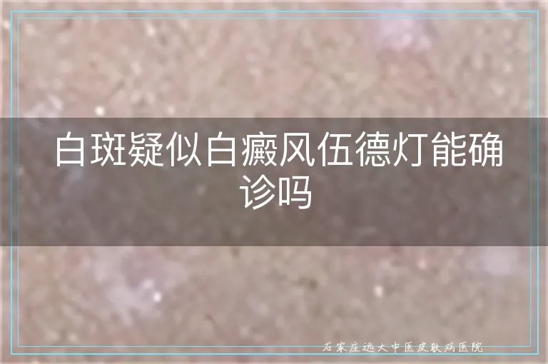 白斑疑似白癜风伍德灯能确诊吗