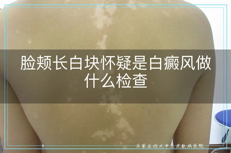 脸颊长白块怀疑是白癜风做什么检查
