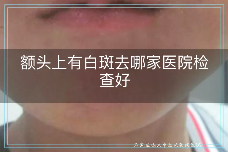 额头上有白斑去哪家医院检查好