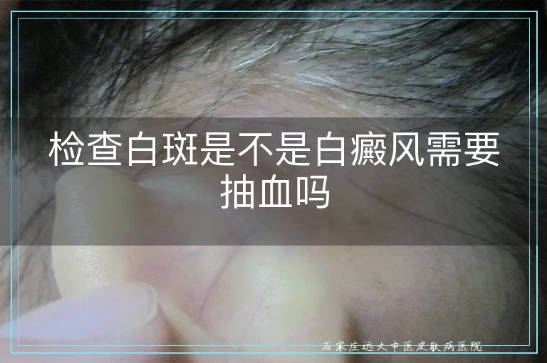 检查白斑是不是白癜风需要抽血吗