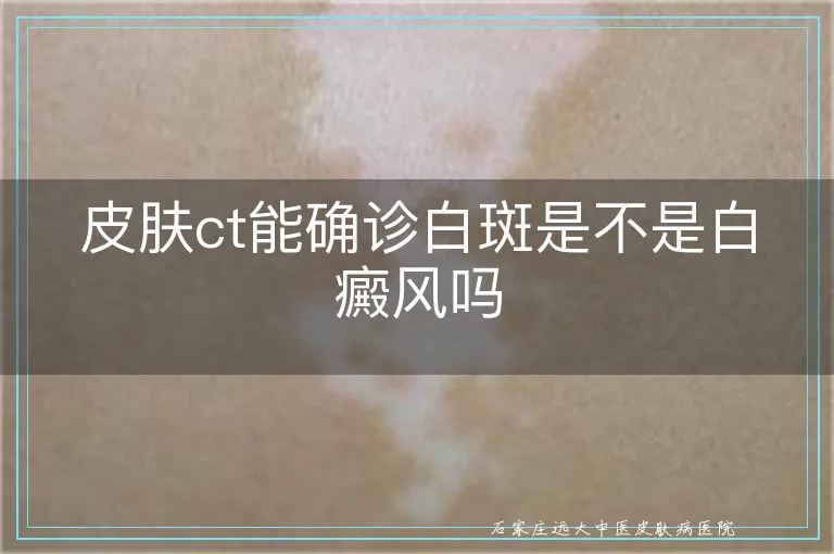 皮肤ct能确诊白斑是不是白癜风吗
