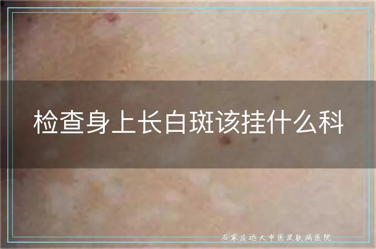 检查身上长白斑该挂什么科