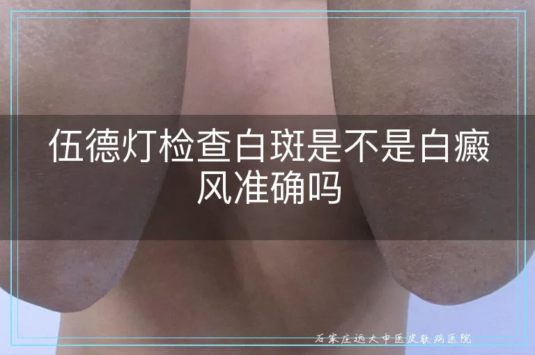 伍德灯检查白斑是不是白癜风准确吗