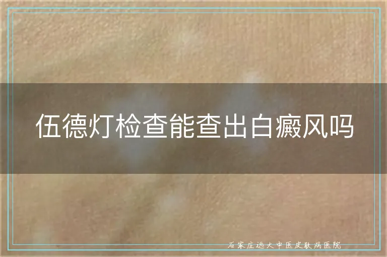 伍德灯检查能查出白癜风吗