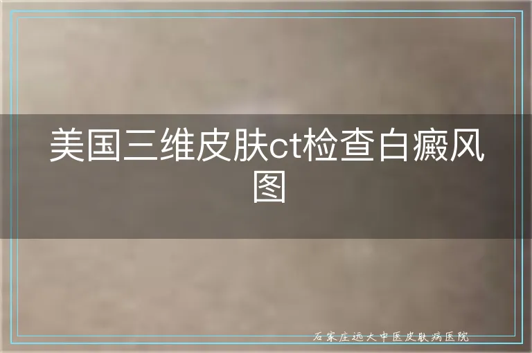 美国三维皮肤ct检查白癜风图