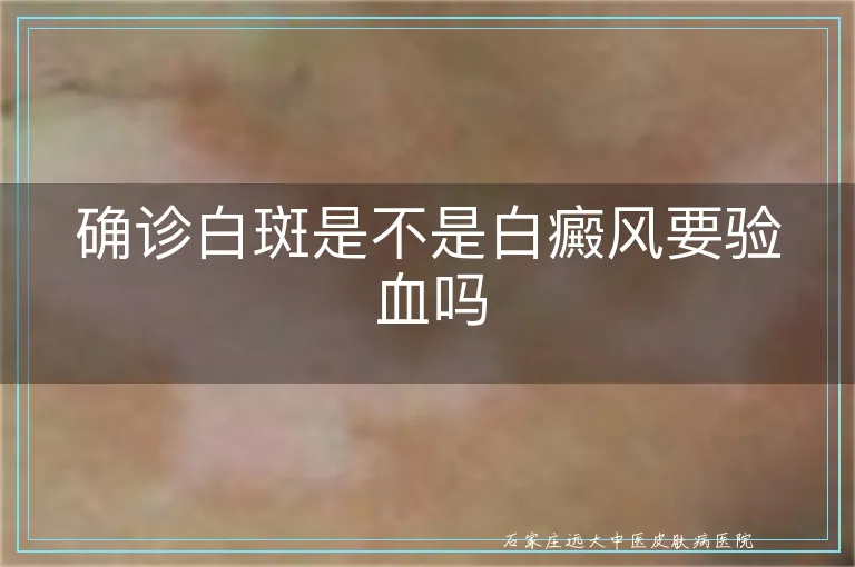 确诊白斑是不是白癜风要验血吗