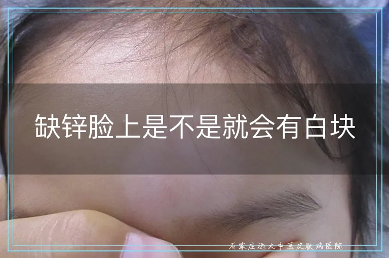 缺锌脸上是不是就会有白块