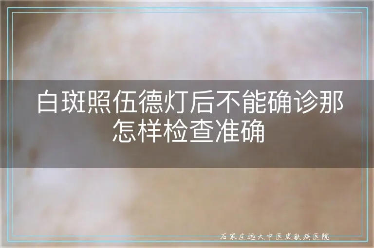 白斑照伍德灯后不能确诊那怎样检查准确