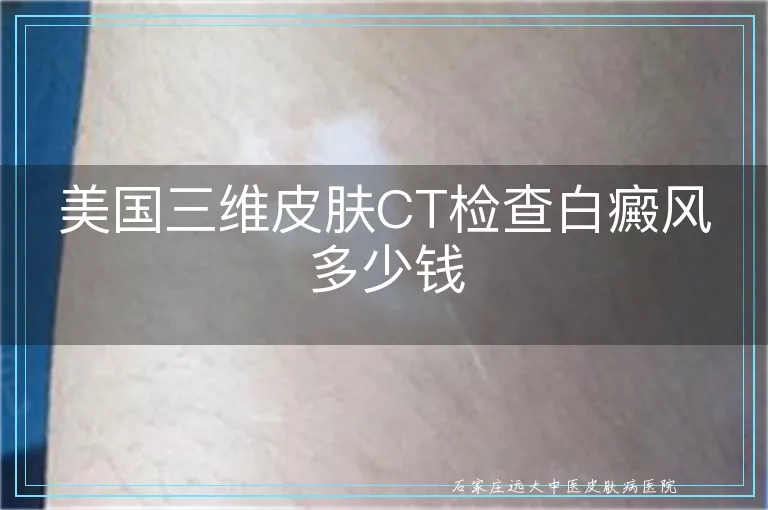 美国三维皮肤CT检查白癜风多少钱