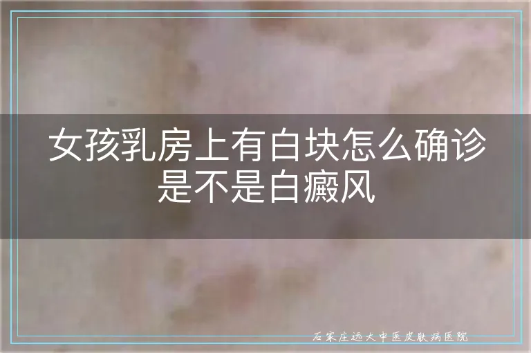 女孩乳房上有白块怎么确诊是不是白癜风