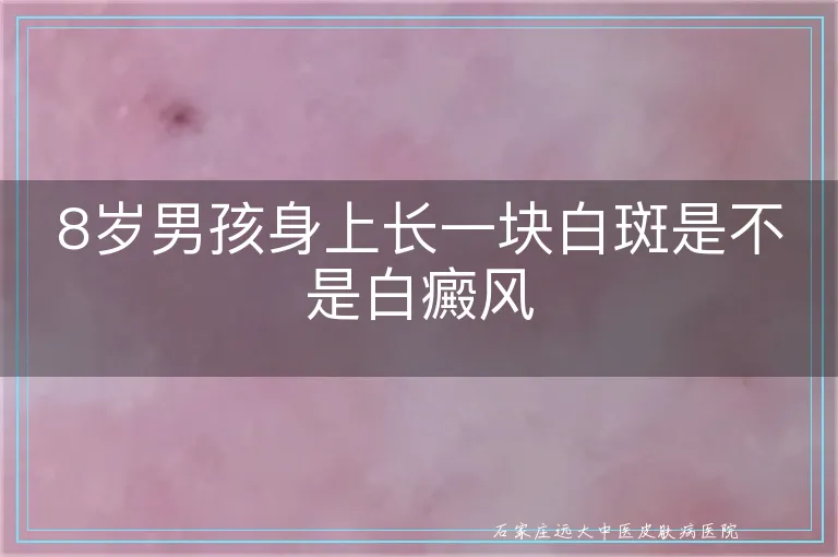 8岁男孩身上长一块白斑是不是白癜风