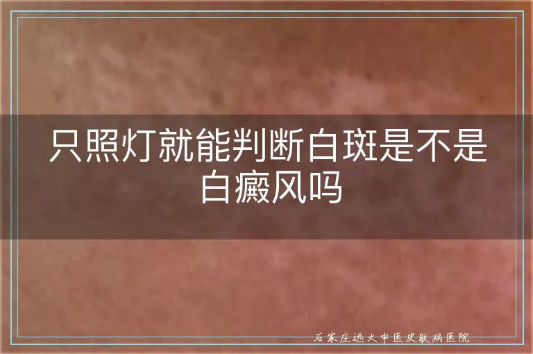 只照灯就能判断白斑是不是白癜风吗