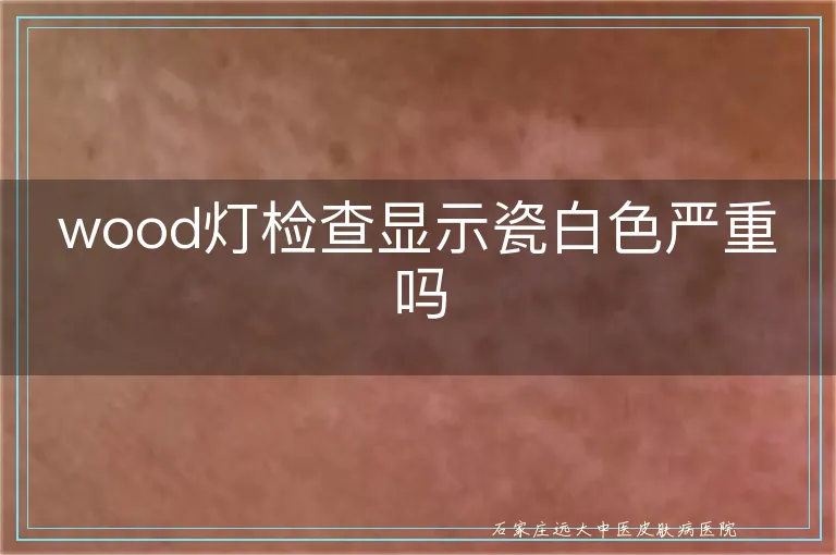 wood灯检查显示瓷白色严重吗
