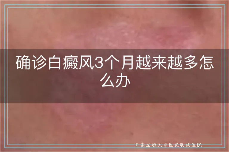 确诊白癜风3个月越来越多怎么办