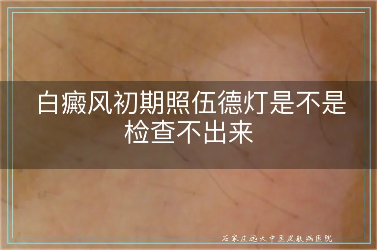 白癜风初期照伍德灯是不是检查不出来