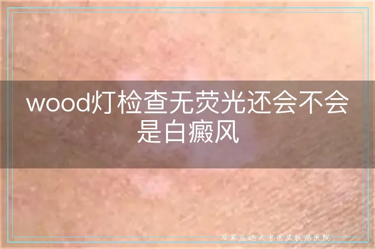 wood灯检查无荧光还会不会是白癜风